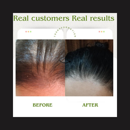 QiRah Complete Hair Repair System (4 to 5 Months Repair Plan)