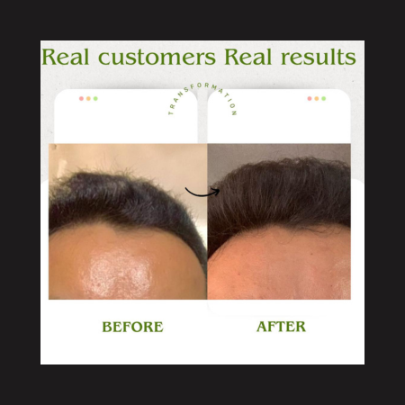 4- Month Visible Hair Growth Plan (100ml × 4) Best Value Pack