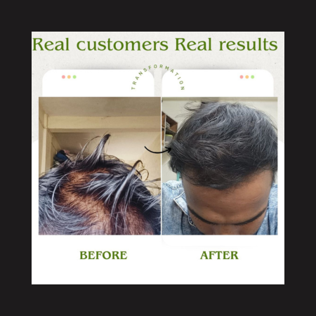 QiRah Complete Hair Repair System (4 to 5 Months Repair Plan)