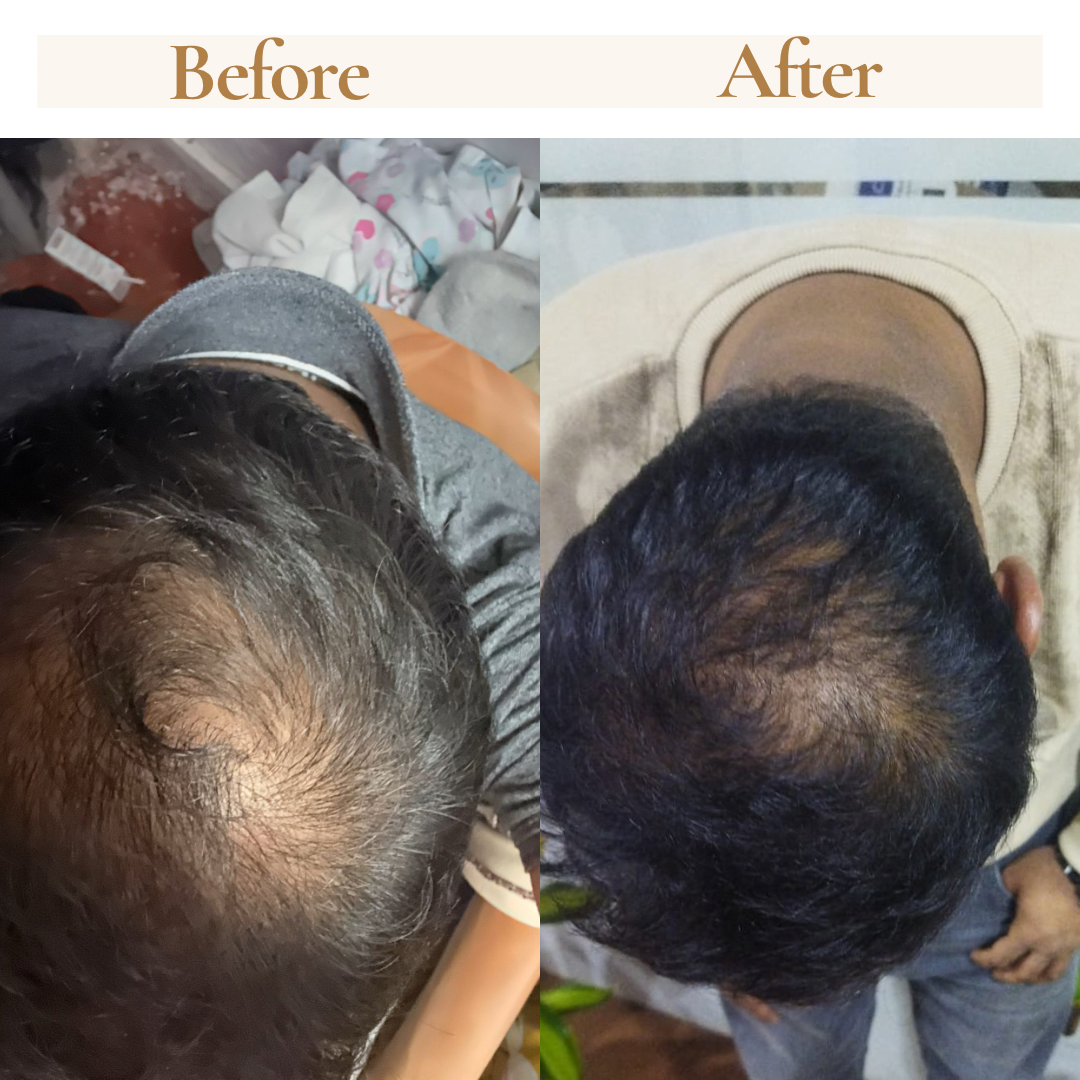 QiRah Complete Hair Repair System (4 to 5 Months Repair Plan)